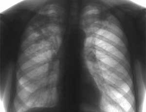 В 21 южноуральском муниципалитете заболеваемость туберкулезом достигла критического уровня